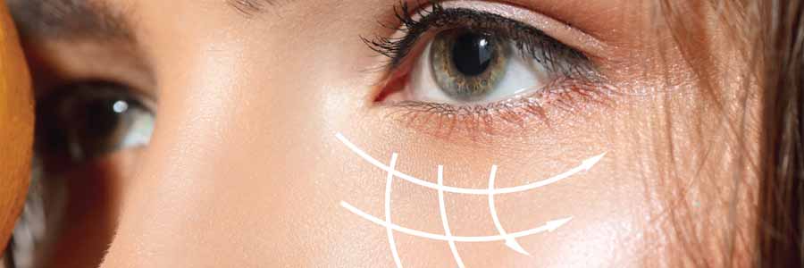 Hilos de ácido poliláctico para Quitar Las Arrugas De Los Ojos