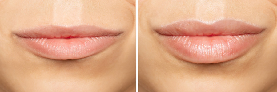 Lifting no invasivo Lip Lift 